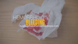 Hemorrhoid bleeding [upl. by Thurman]