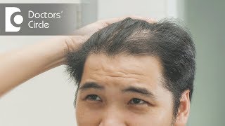 How to treat hair thinning in front part of the scalp  Dr Nischal K [upl. by Jone]