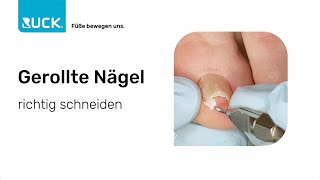 Gerollte Nägel – Ursachen und Therapiemöglichkeiten [upl. by Enyak569]