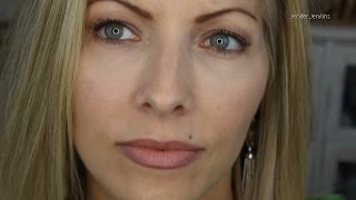 Restylane Filler Injections for Under Eye Puffiness  4 mo Follow Up [upl. by Burkhart]