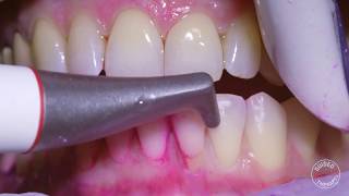 How teeth should be cleaned at the Dentist  Hygienist [upl. by Accever]