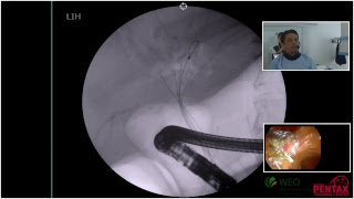 Intrahepatic biliary tract dilation [upl. by Assereht]