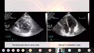 21 06 04 Echocardiogram interpretation [upl. by Yorgen]