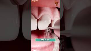 How teeth are fixed 😳 दांत कैसे ठीक होते हैं  shorts [upl. by Lamiv]