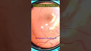 Normal fundus  Normal Retina  Smartphone Fundus Videography  Fundus Photography  Short Video 149 [upl. by Huntingdon]