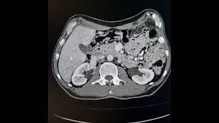 Scirrhous carcinoma of stomach [upl. by Rieger828]