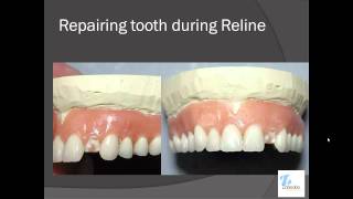 Closed Flask Denture Reline Technique [upl. by Artenehs]