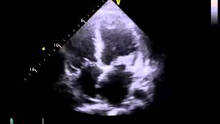 Echocardiography to Assess MitralValve Leaflets  NEJM [upl. by Iuqcaj478]