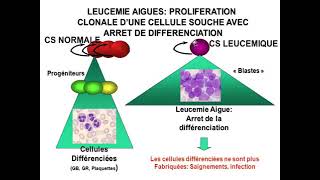 Hemato 12Hémopathies malignes et leucémies aigues Dr Abbadi [upl. by Haydon6]