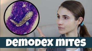 DEMODEX MITES ON YOUR SKIN DR DRAY [upl. by Werna780]