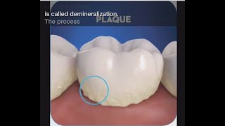 Stage 1 of Tooth Decay Demineralization [upl. by Anen771]