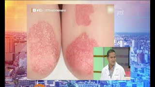 En nuestro segmento médico hablamos sobre la psoriasis [upl. by Sert]