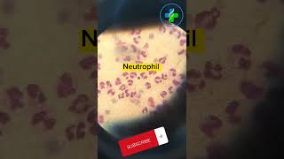 High neutrophil count in peripheral smear  neutrophils  CBC  Causes of Neutrophilia  hematology [upl. by Karim419]