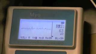 Myoguide and Ultrasound Guided Piriformis Syndrome Injection [upl. by Eatnoled888]