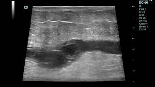 Superficial Thrombophlebitisthrombosis of Great Saphenous Vein [upl. by Niak]