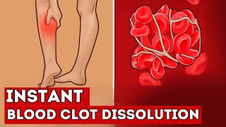 These 7 FOODS Instantly Dissolve Blood Clots in Your Vessels [upl. by Schwinn]