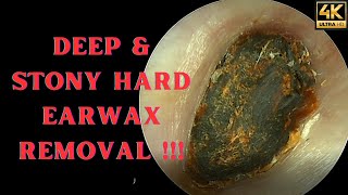 DEEP amp Stony HARD Earwax Removal Very Satisfying Video [upl. by Samau]