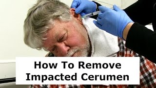 Removing Impacted Cerumen from a Patients Ear [upl. by Ulrich74]