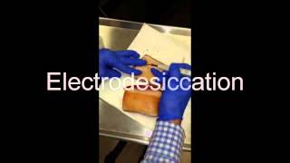 Electrodesiccation and Curettage EDampC  How To [upl. by Inalawi735]