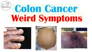 Colon Cancer Weird Symptoms amp Why They Occur [upl. by Elauqsap]