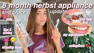 8 month HERBST APPLIANCE and BRACES update 🦷💞 my experience dental routine advice amp more [upl. by Bender]