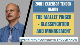 Zone I Extensor injury Mallet finger Everything you should know about it The splint the surgery [upl. by Anahgem957]