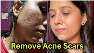 How to remove acne scars 😍  Acne scars remove treatment  My skin transformation journey [upl. by Renat]