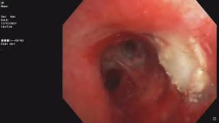 Central Airway Tumor  Bronchoscopic recanalisation  Pleomorphic adenoma [upl. by Brunhild]