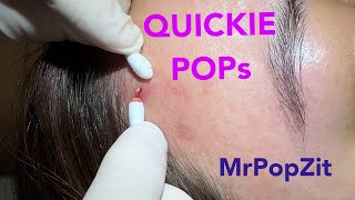 Quickie keratin plug core pops Acne extractions Link below to MrPopZit Live [upl. by Lebasile429]