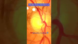 Normal fundus  Normal Retina  Smartphone Fundus Videography  Fundus Photography  Short Video 176 [upl. by Soule]