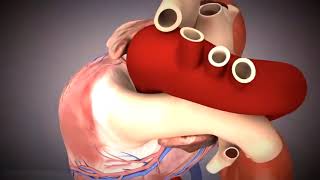 TAVR Transcatheter Aortic Valve Replacement Animation [upl. by Eahsan]