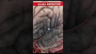 कैसे लकवा आता हैHow does stroke occur animation videoshortsanimation [upl. by Arzed]