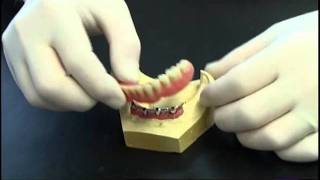 Prothese clipsee sur implant avec barre [upl. by Arocal21]