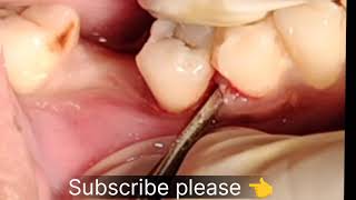 mandibular right side second premolar extraction niche ki daal kaise nikaledentition [upl. by Ahsrav]