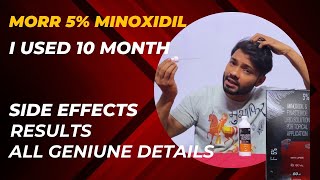 Minoxidil Morr f 5 Results  Morr F 5  Minoxidil and finasteride side effects [upl. by Nalyd59]