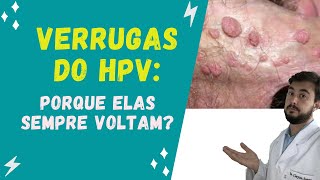 Porque as verrugas do HPV podem voltar [upl. by Anikahs]