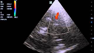 transcranial doppler of RT MCA in severe brain oedema with prominent pulsation [upl. by Anaya]