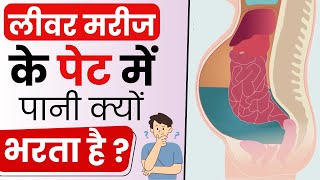 जलोदर Ascites क्या होता है  Ascites Causes Symptoms and Treatment  Bharat Homeopathy [upl. by Sirob549]