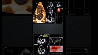 shorts Echo in HFrEF Must include RV amp LA functions echo [upl. by Elcarim]