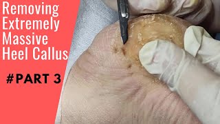 Removing Extremely Massive Heel Callus  Bones Under Pressure  Foot Care Callus Podiatry Part 3 [upl. by Miun]