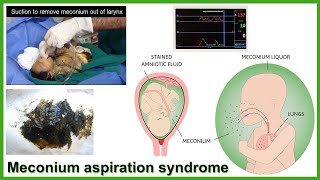 Meconium aspiration syndrome updates [upl. by Chor504]