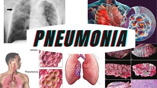 pneumonia  types stages causes prevention amp diagnosis [upl. by Kelsi247]