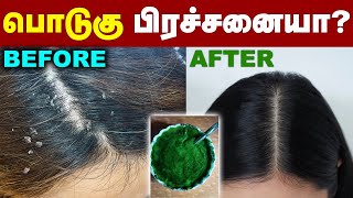 பொடுகு பிரச்சனையில இருந்து தப்பிக்க இது தான் வழி  dandruff treatment at home  Men amp Women [upl. by Niai]