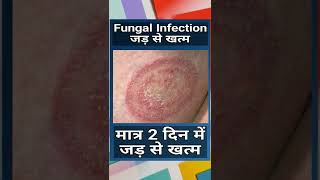 Fungal Infection Treatment  Fangal Infeksan In Skin  Fungal Infection Kaise Hota Hai [upl. by Kirrad581]