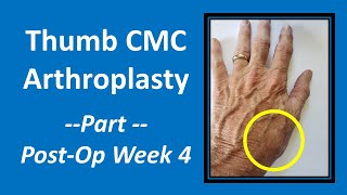 Thumb CMC Arthroplasty Part 4 PostOp Week 4 cmc [upl. by Neeroc344]