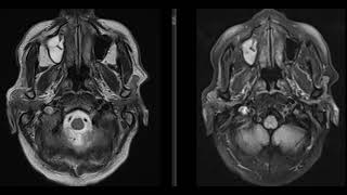 case 5  45 year old male patient with fever and headache [upl. by Otecina]