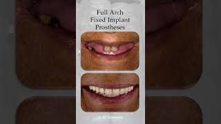 What does a successful full fixed implant prostheses look like dentalprosthetics implantdentistry [upl. by Andrew952]