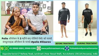 Polio ऑपरेशन के 3 महीने बाद पोलियो पेशेंट को फायदे कंप्यूटराइज़्ड ऑपरेशन के फायदे polio treatment [upl. by Tansy]