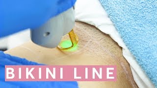 Laser Hair Removal Bikini THIS is how it works [upl. by Otokam]