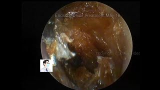 Reexamination of cholesteatoma of the external auditory canal 20220516 [upl. by Nyrrat]